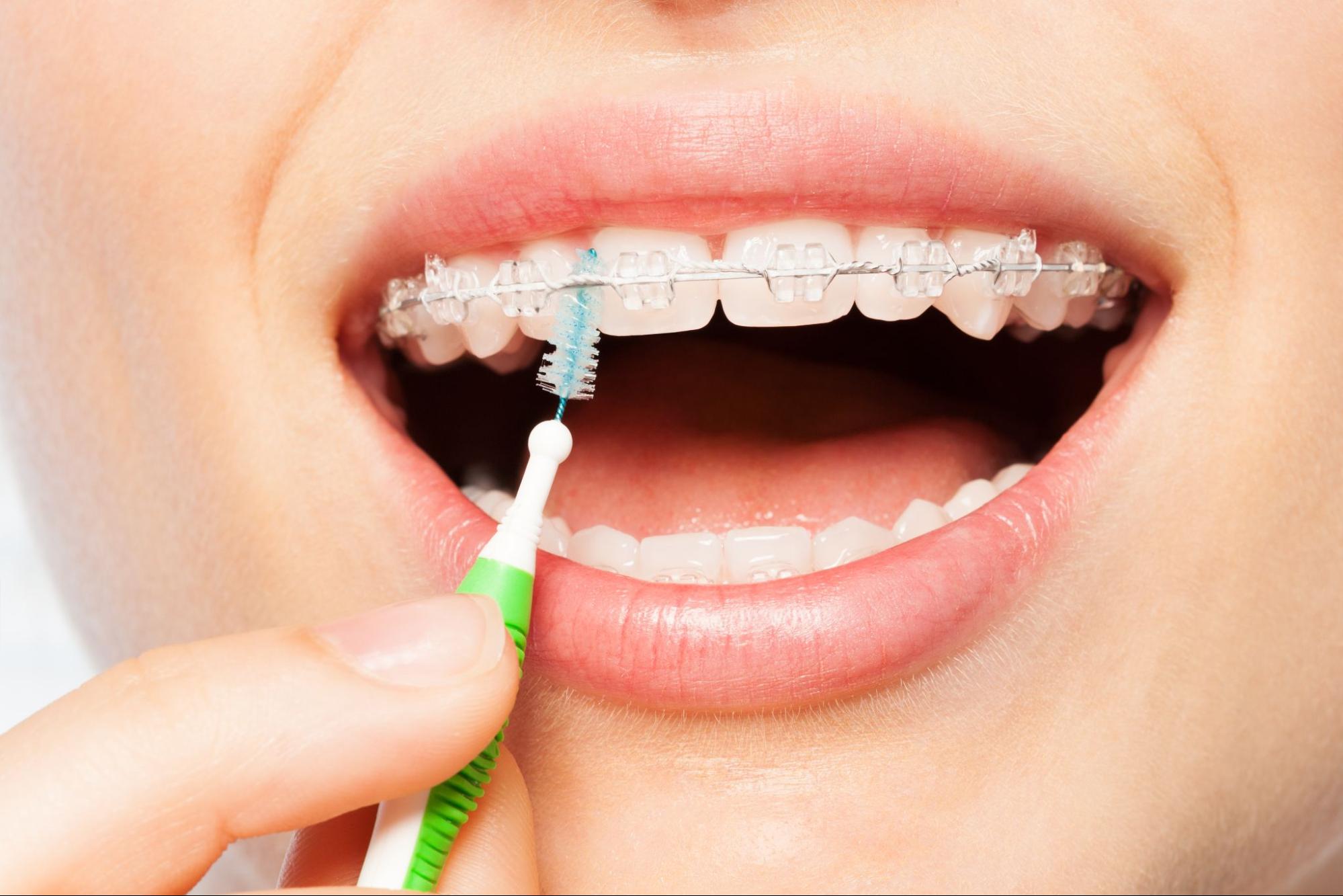 How Can I Prevent Bad Breath While Wearing Braces?
