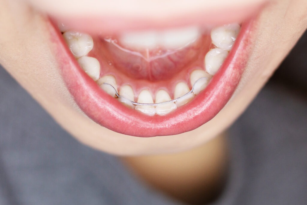 Lower teeth with a fixed lingual retainer - Texas Family Orthodontics in San Antonio.