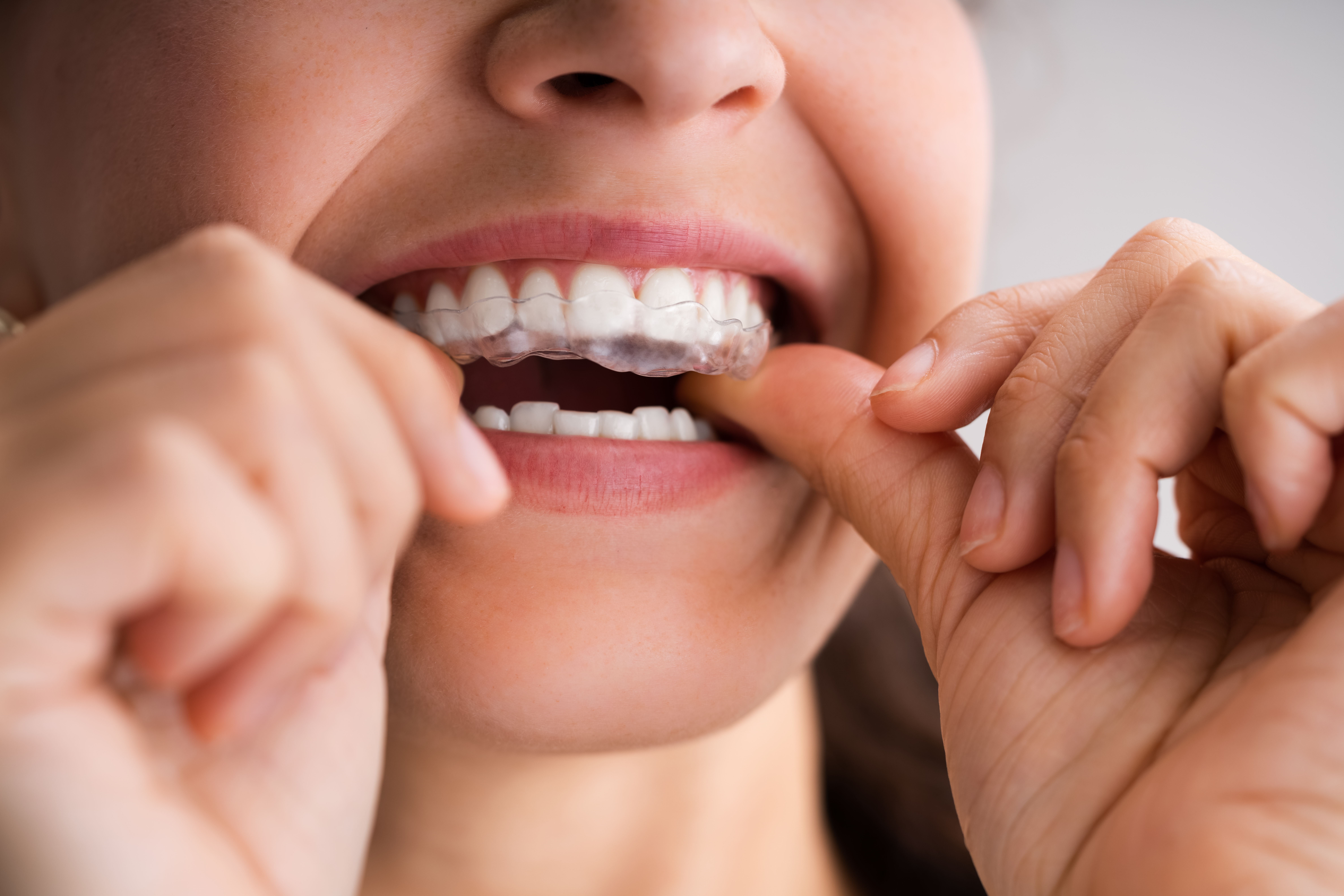Woman putting in her San Antonio clear aligners.
