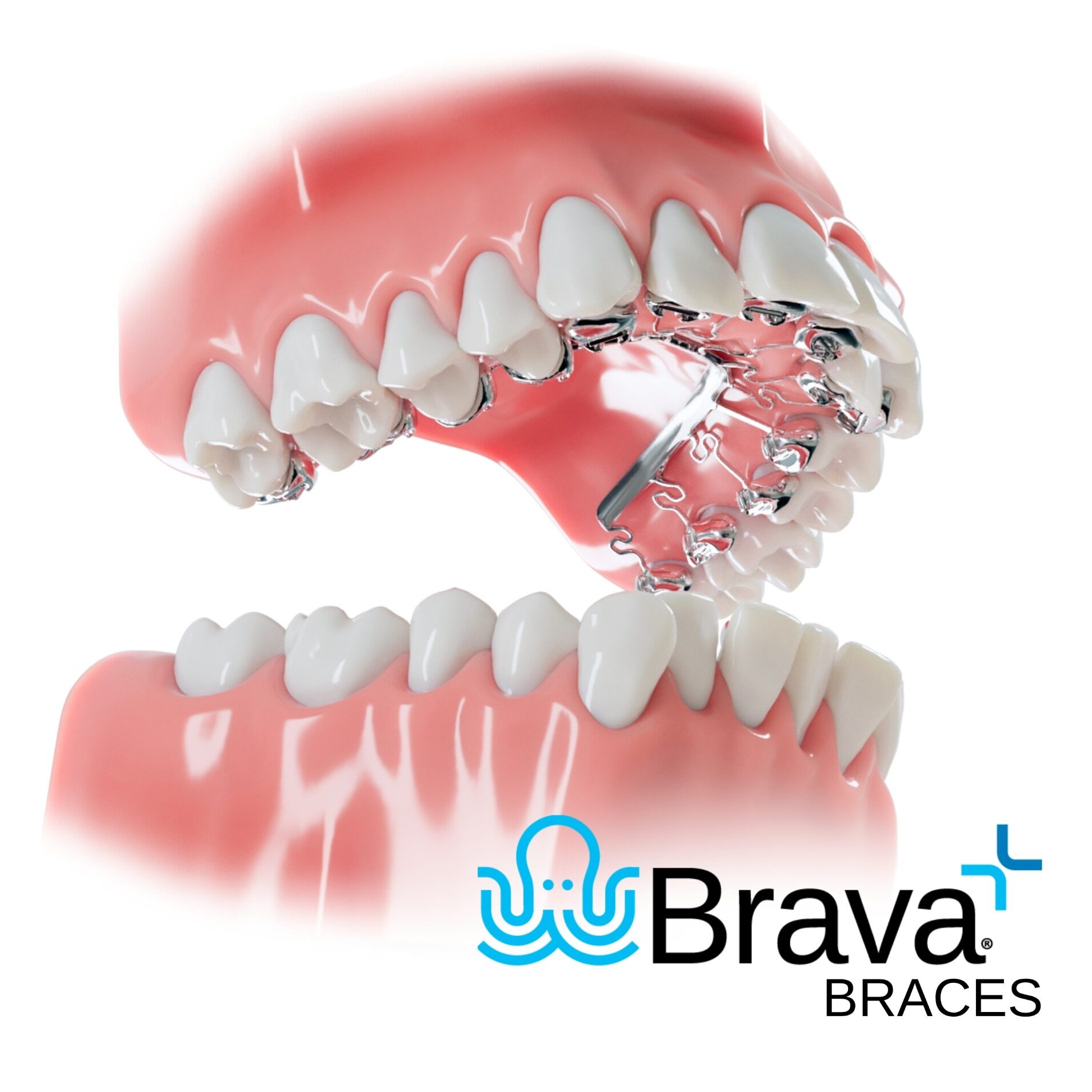 Brava-hidden-braces-upper-invisible (1) Brava-hidden-braces-upper-invisible (1)